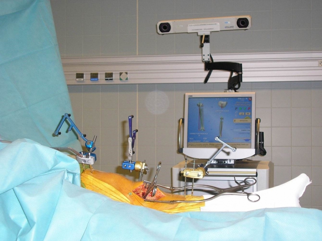 système navigation opération chirurgie
