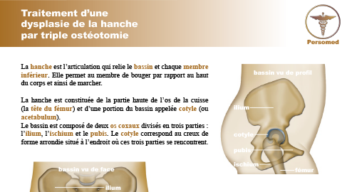 Enfant : Traitement d’une dysplasie de la hanche par triple ostéotomie