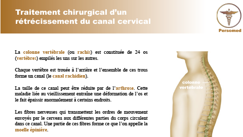 Traitement chirurgical d’un rétrécissement du canal cervical