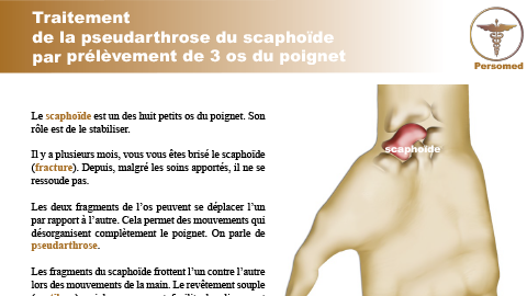 Traitement de la pseudarthrose du scaphoïde par prélèvement de 3 os du poignet