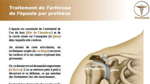 Traitement de l’arthrose de l’épaule par prothèse