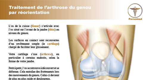Traitement de l’arthrose du genou par réorientation