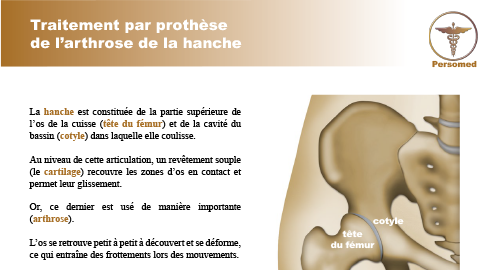 Traitement par prothèse de l’arthrose de la hanche