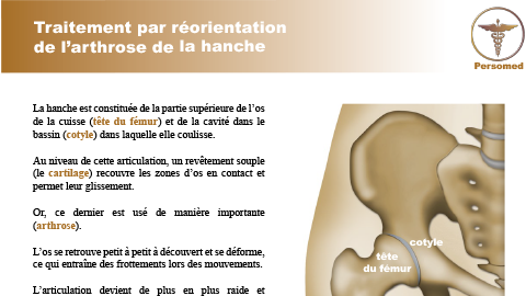 Traitement par réorientation de l’arthrose de la hanche