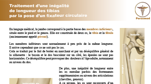 Enfant : Traitement d’une inégalité de longueur des tibias par la pose d’un fixateur circulaire