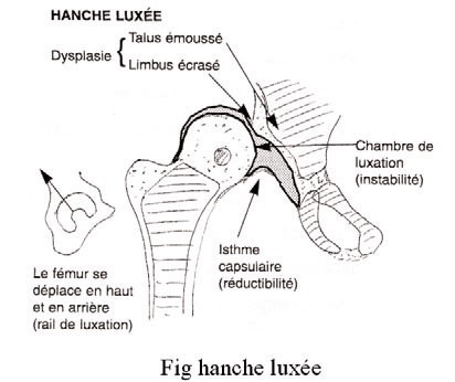 luxation congenitale hanche