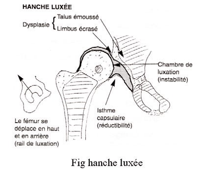 5 Questions Sur La Luxation Congenitale De La Hanche Des Nouveaux Nes Sofcot