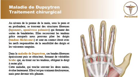 Maladie de Dupuytren Traitement chirurgical