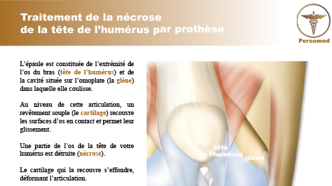 Traitement de la nécrose de la tête de l’humérus par prothèse