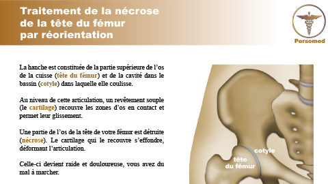 Traitement de la nécrose de la tête du fémur par réorientation