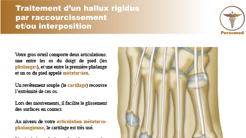 Traitement d’un hallux rigidus par raccourcissement et/ou interposition