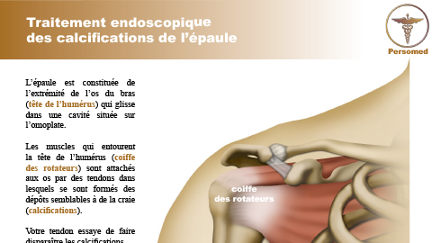 Traitement endoscopique des calcifications de l’épaule