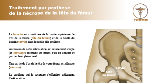 Traitement par prothèse de la nécrose de la tête du fémur