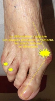 hallux valgus