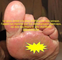 hallux valgus