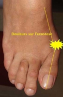 hallux valgus