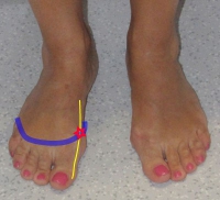 hallux valgus