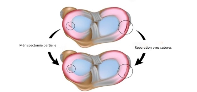 ménisque traitement