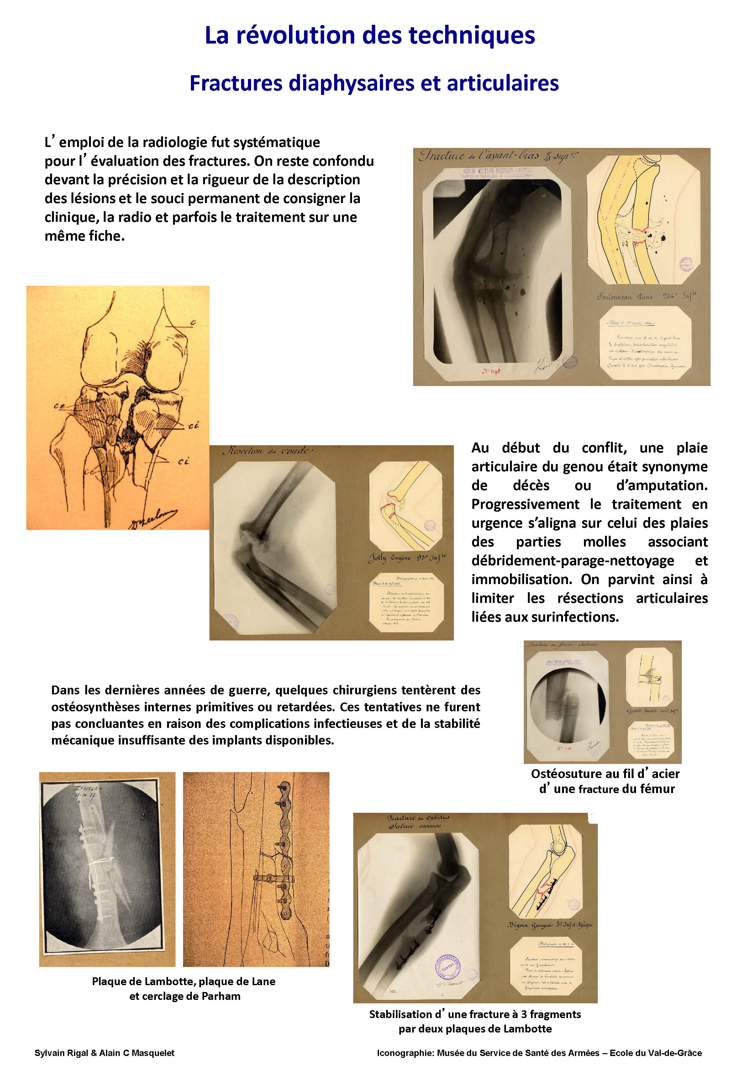 La révolution des techniques. Fractures diaphysaires et articulaires