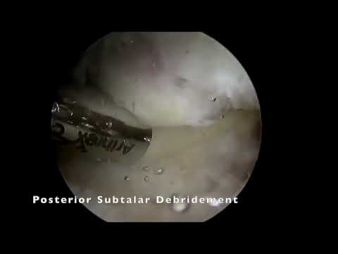 Vidéo du mois février 2023 : Subtalar and talonavicular arthrodesis under lateral arthroscopy