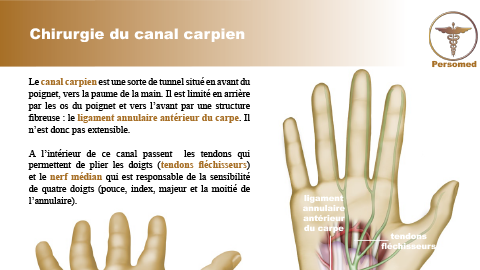 Chirurgie du canal carpien