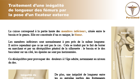 Enfant : Traitement d’une inégalité de longueur des fémurs par la pose d’un fixateur externe