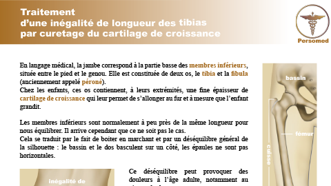 Enfant : Traitement d’une inégalité de longueur des tibias par curetage du cartilage de croissance