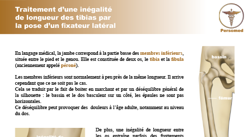 Enfant : Traitement d’une inégalité de longueur des tibias par la pose d’un fixateur latéral