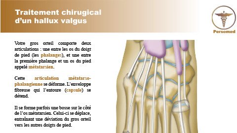 Traitement chirugical d’un hallux valgus