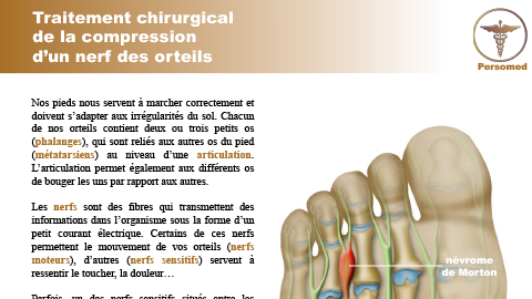 Traitement chirurgical de la compression d’un nerf des orteils