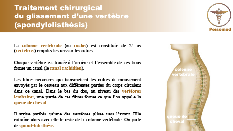 Traitement chirurgical du glissement d’une vertèbre (spondylolisthésis)