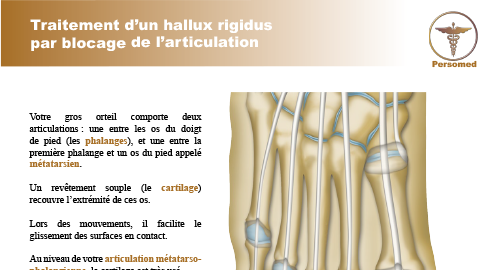 Traitement d’un hallux rigidus par blocage de l’articulation