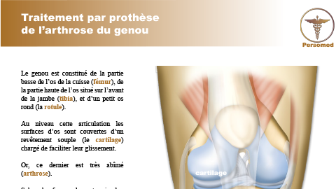 Traitement par prothèse de l’arthrose du genou