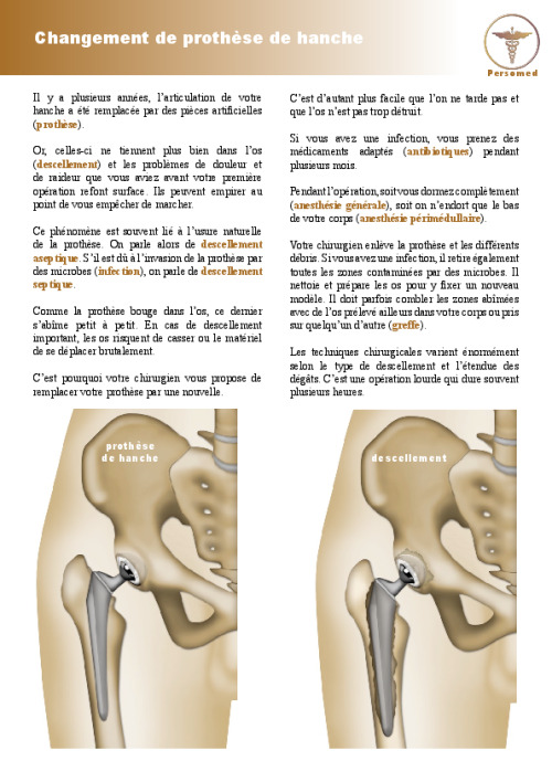 Changement de prothèse de hanche