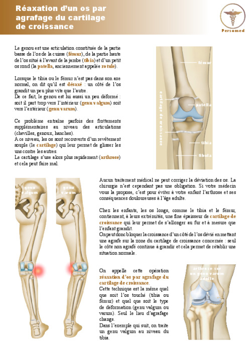 Enfant : Réaxation d’un os par agrafage du cartilage de croissance