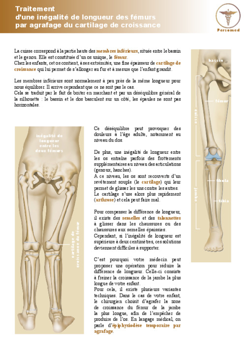 Enfant : Traitement d’une inégalité de longueur des fémurs par agrafage du cartilage de croissance