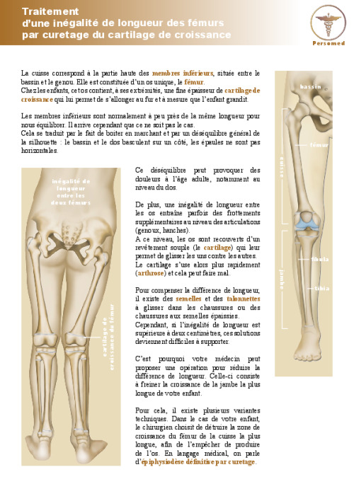 Enfant : Traitement d’une inégalité de longueur des fémurs par curetage du cartilage de croissance