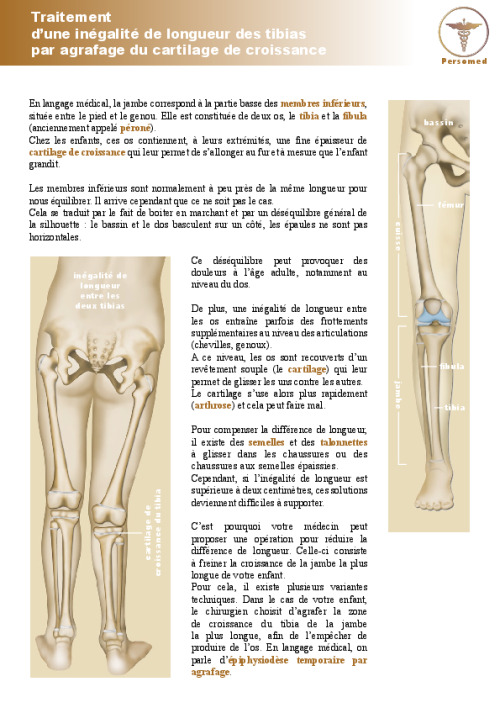 Enfant : Traitement d’une inégalité de longueur des tibias par agrafage du cartilage de croissance