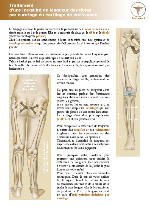 Enfant : Traitement d’une inégalité de longueur des tibias par curetage du cartilage de croissance
