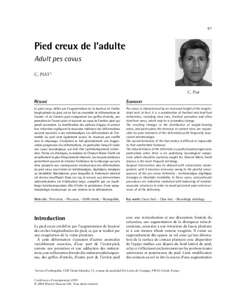 Pied creux de l’adulte