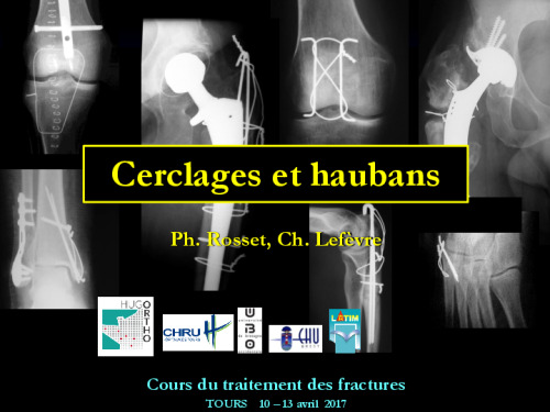 cours de Tours 2017 : traitement des fractures