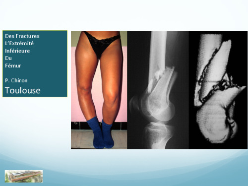 cours de Tours 2017 : traitement des fractures - 3