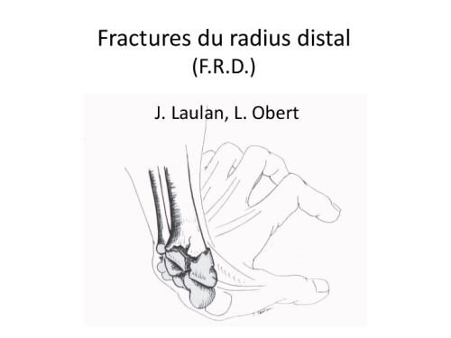 cours de Tours 2017 : traitement des fractures - 6