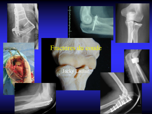 cours de Tours 2017 : traitement des fractures - 11