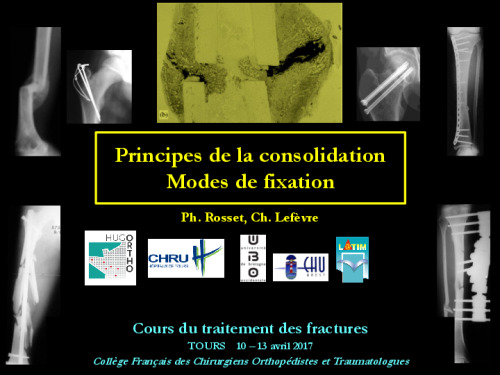 cours de Tours 2017 : traitement des fractures - 20