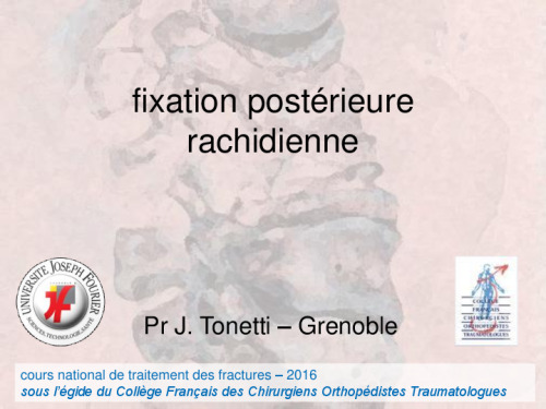 cours de Tours 2017 : traitement des fractures - 26