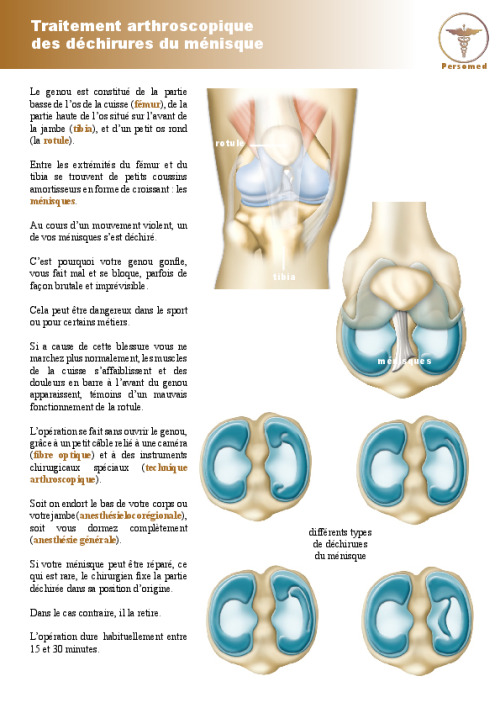 Traitement arthroscopique des déchirures du ménisque