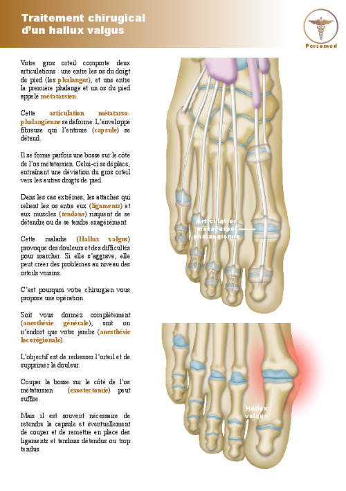 Traitement chirugical d’un hallux valgus