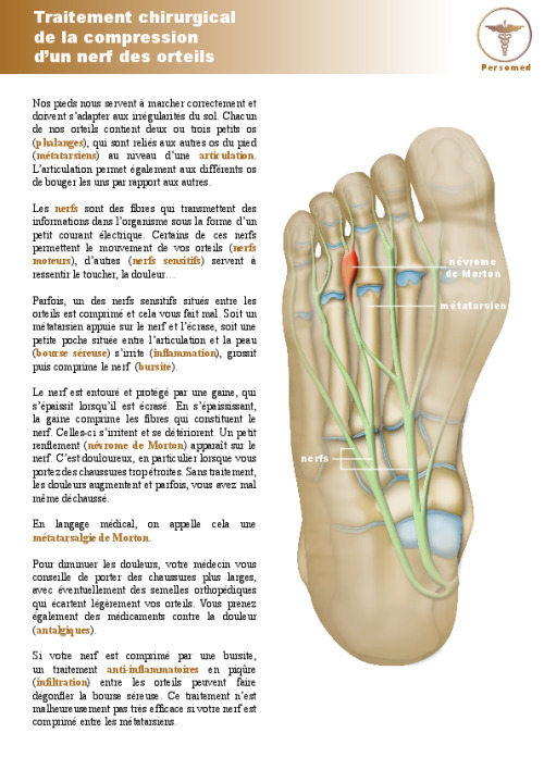 Traitement chirurgical de la compression d’un nerf des orteils