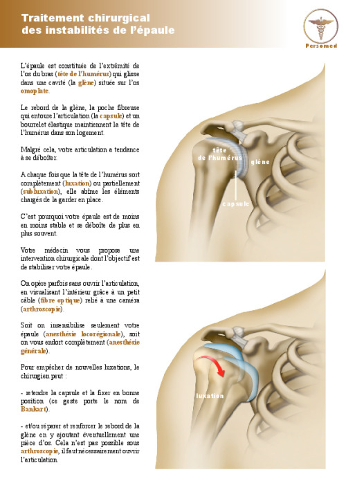 Traitement chirurgical des instabilités de l’épaule